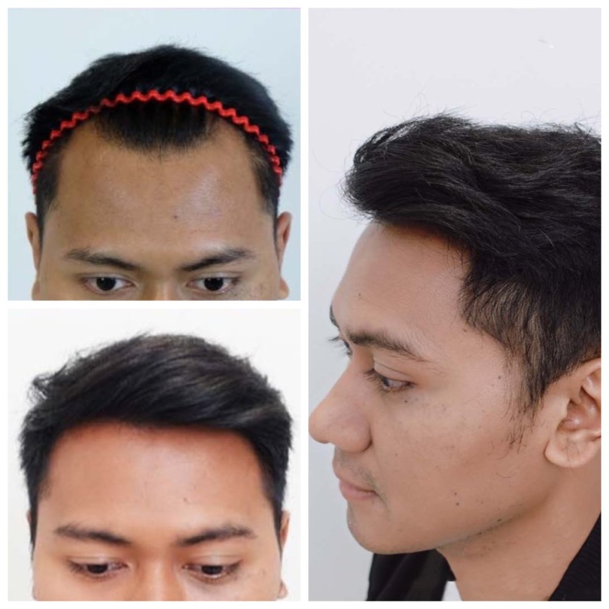 Before and after DHI hair transplant result at Department of Hair, Aesthetics & Surgery Navamin 9