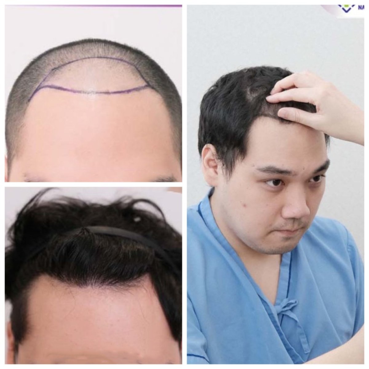 DHI hair transplant before and after results at Navamin 9 Hospital, restored hairline in male patient