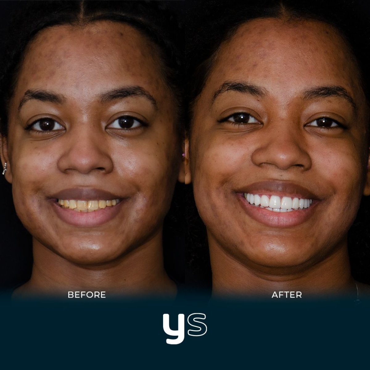 Résultat avant/après pose de couronnes zircone chez YeahSmile – sourire naturel éclatant