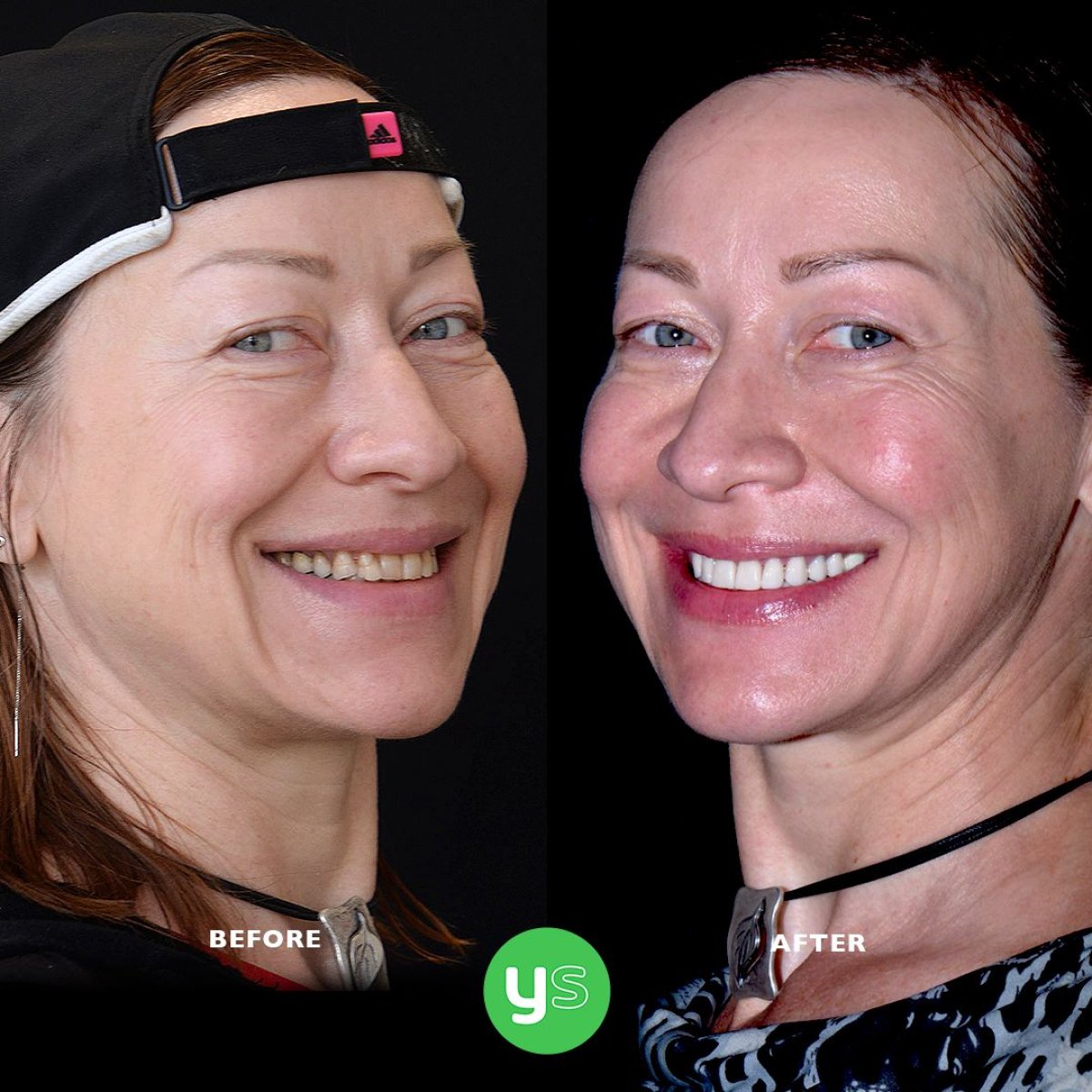قبل وبعد تركيب تيجان الزركونيا في YeahSmile – تحول ملحوظ في الابتسامة