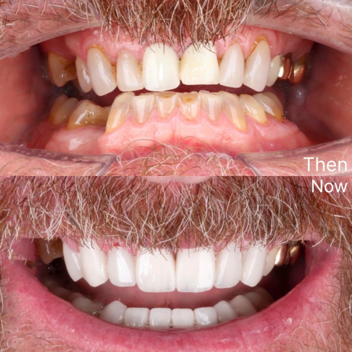 نتائج قبل وبعد تركيب تيجان الأسنان في SmileBox Dental Clinic - Thonglor, Sukhumvit