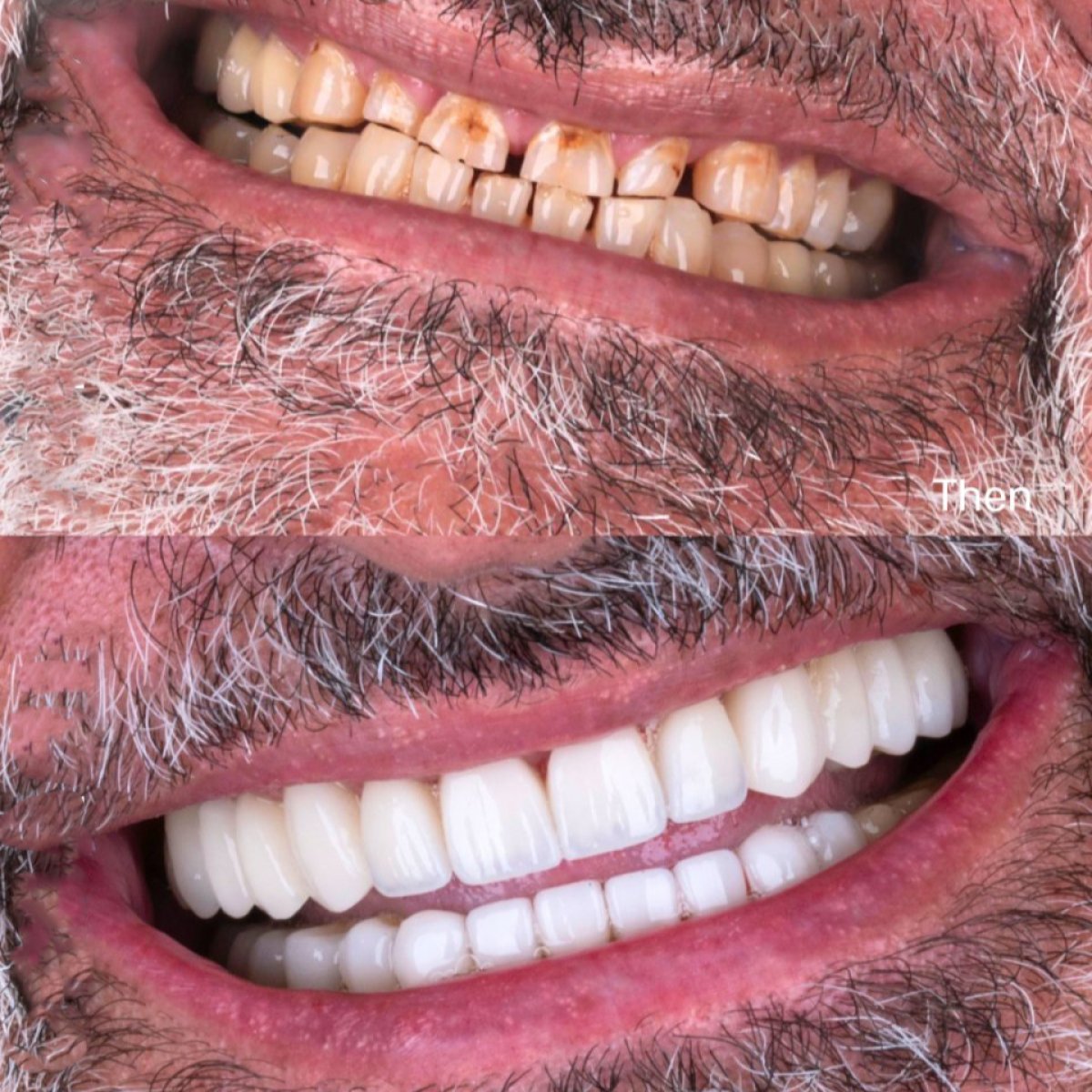 Resultado antes y después de coronas dentales en SmileBox Dental Clinic - Thonglor, Sukhumvit