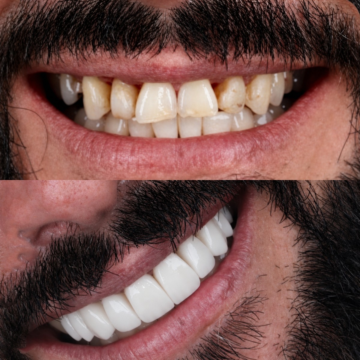 نتائج قبل وبعد تركيب تيجان الأسنان في SmileBox Dental Clinic - Thonglor, Sukhumvit
