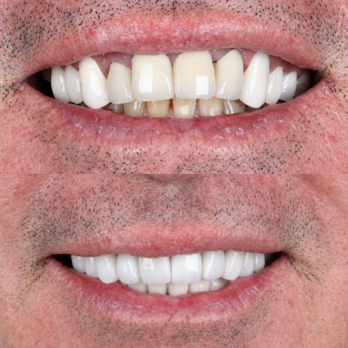 Before and after dental crown installation results at SmileBox Dental Clinic - Thonglor, Sukhumvit