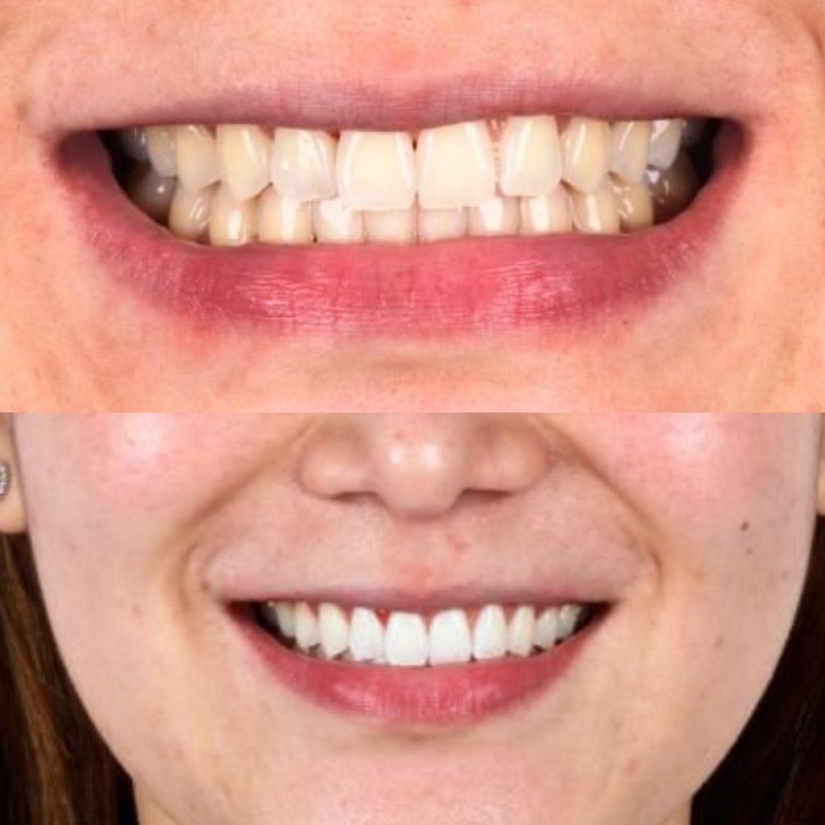 نتائج قبل وبعد تبييض الأسنان بالليزر في SmileBox Dental Clinic - Thonglor، Sukhumvit