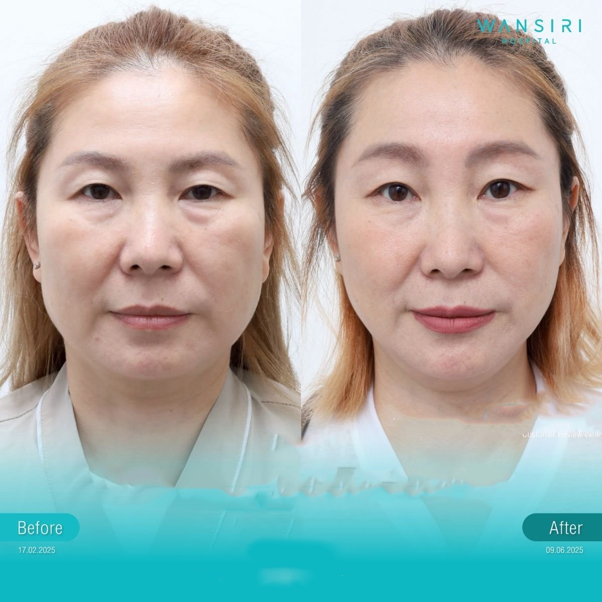 Resultados de lifting de frente antes y después en Wansiri Hospital, rejuvenecimiento visible