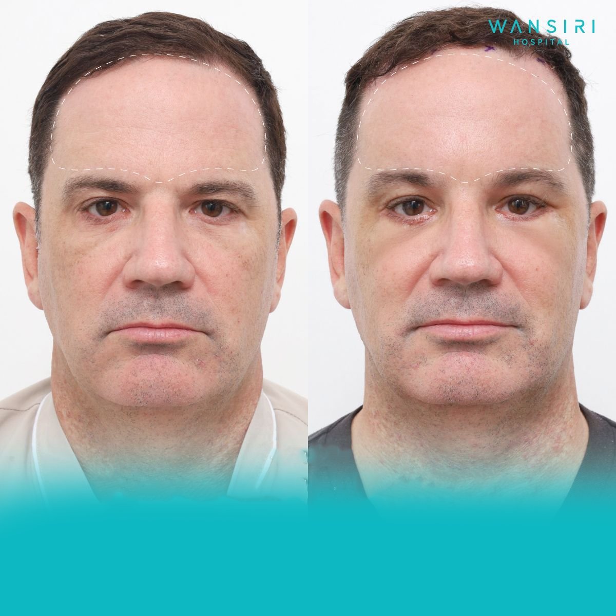 Forehead lift before and after results at Wansiri Hospital, visible brow elevation improvement