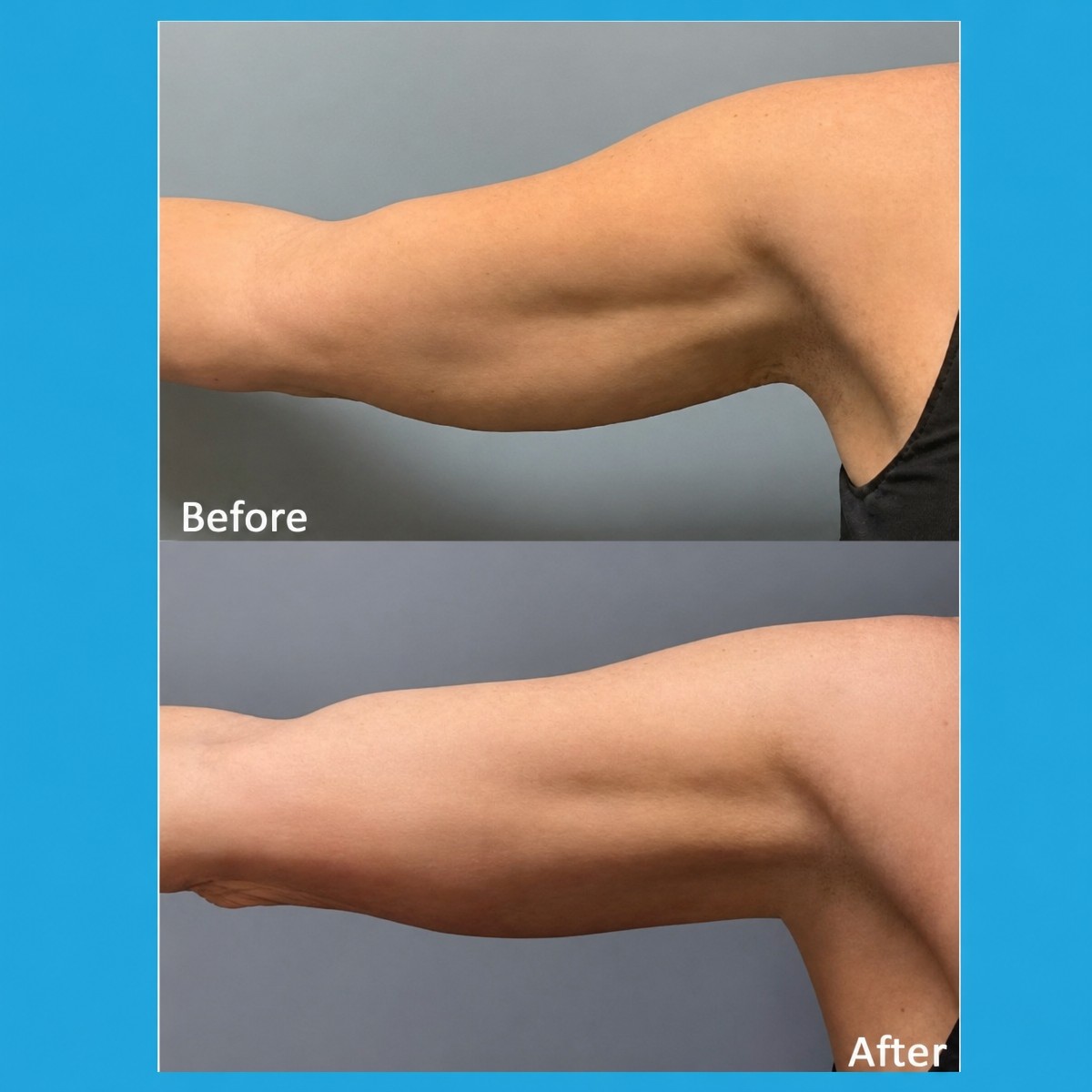 Before and after Cryolipolysis arm fat reduction results at ID Clinic Bangkok