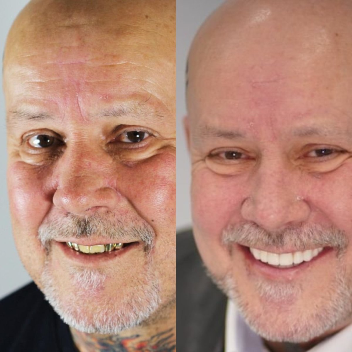 Résultat avant/après implants All-on-6 à Avangart Dental Clinic, restauration du sourire