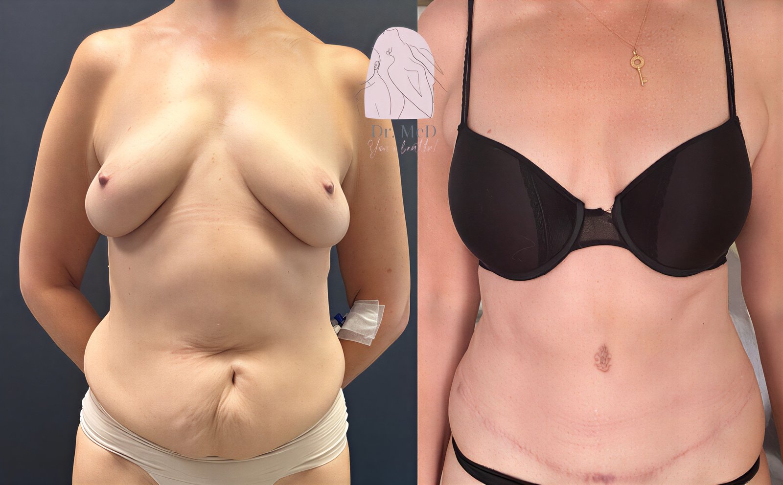نتائج قبل وبعد شفط الدهون Vaser 3 مناطق مع شد البطن في Dr. MED، تحسين شكل الجسم