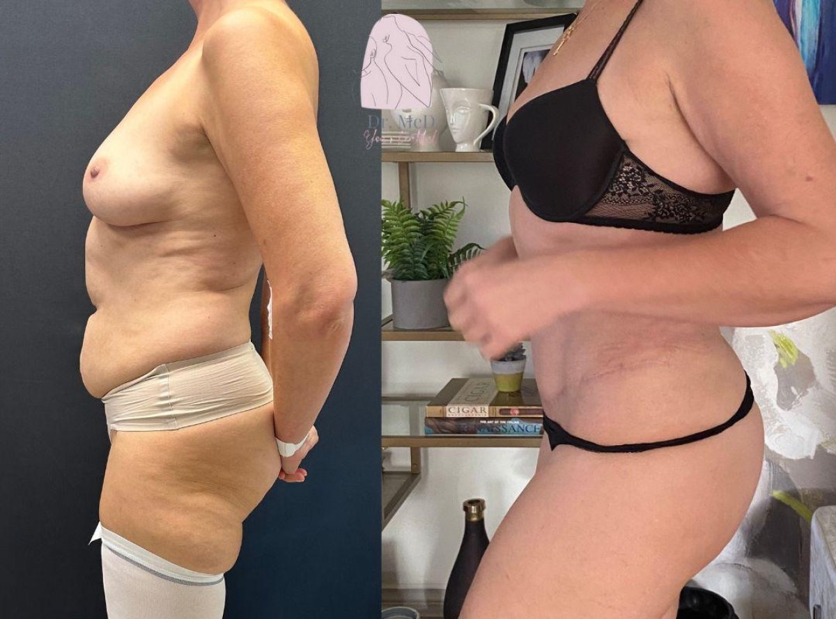 Before and after Vaser 3 areas plus tummy tuck results at Dr. MED – improved body contour
