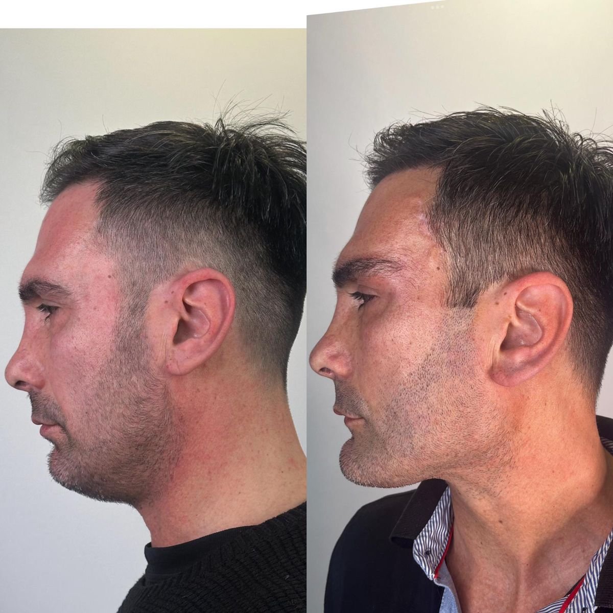 نتائج قبل وبعد زراعة الذقن في عيادة Prof. Furkan Karabekmez لجراحة التجميل