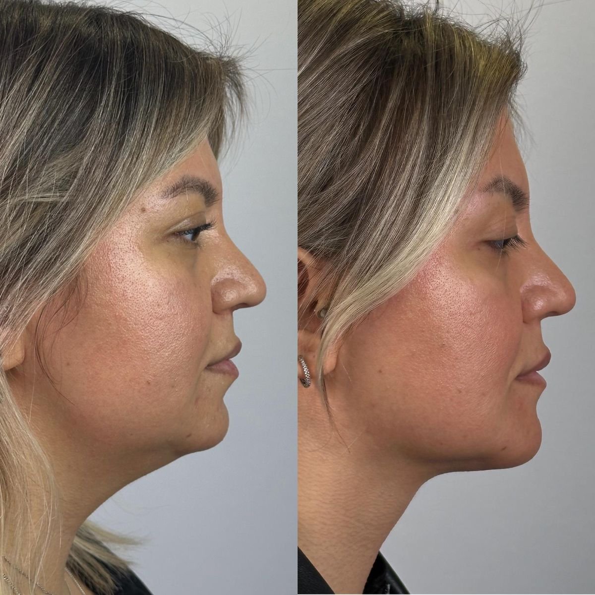Before and after chin implant result at Prof. Furkan Karabekmez's Aesthetic Surgery Clinic