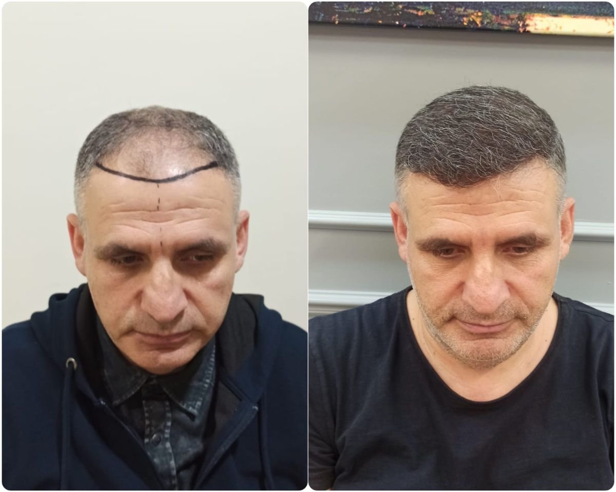 Resultados de trasplante capilar antes y después en Liv Bona Dea Hospital Baku, línea restaurada