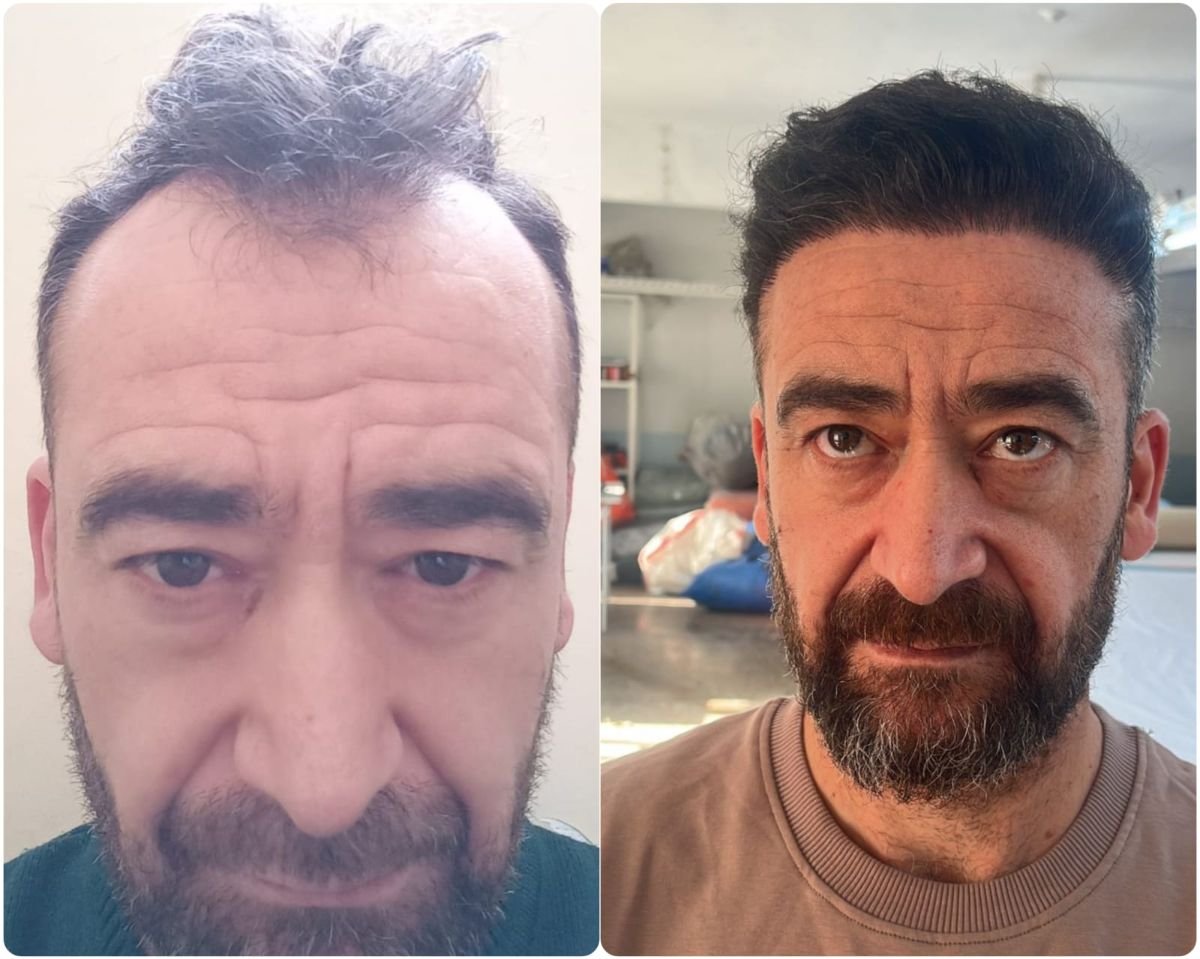 Before and after hair transplant results at Liv Bona Dea Hospital Baku, restored hairline