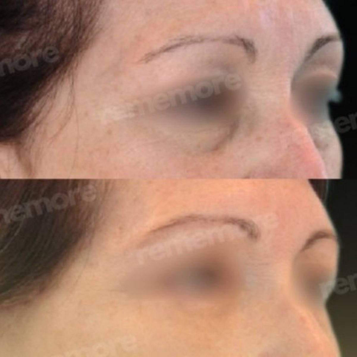 Forehead lift before and after results at Memorial Şişli Hospital, smoother brow appearance
