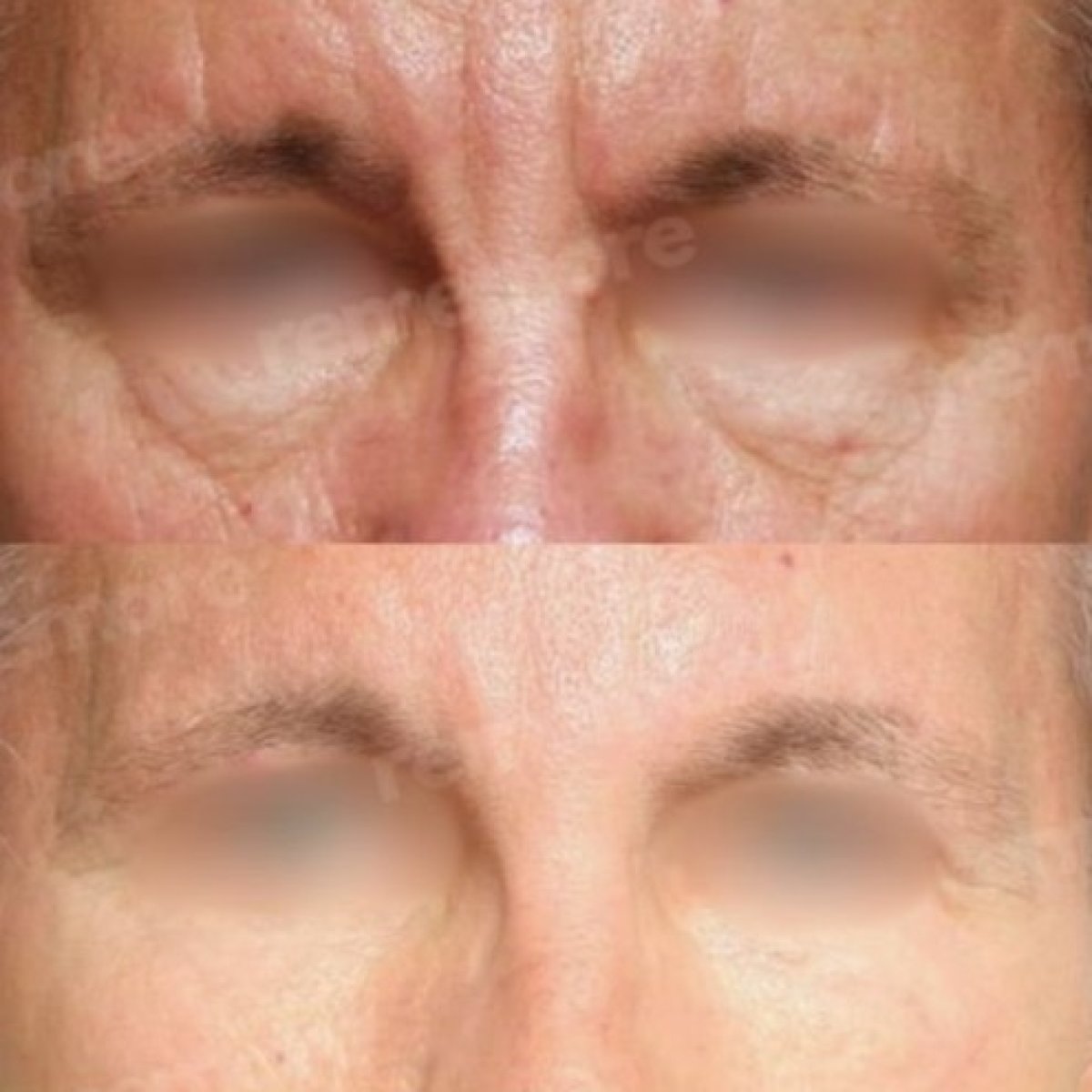 Forehead lift before and after results at Memorial Şişli Hospital, reduced wrinkles and smoother skin