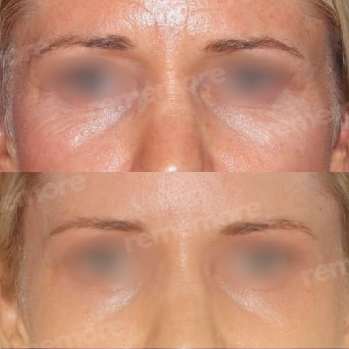 Forehead lift before and after results at Memorial Şişli Hospital, smoother forehead appearance
