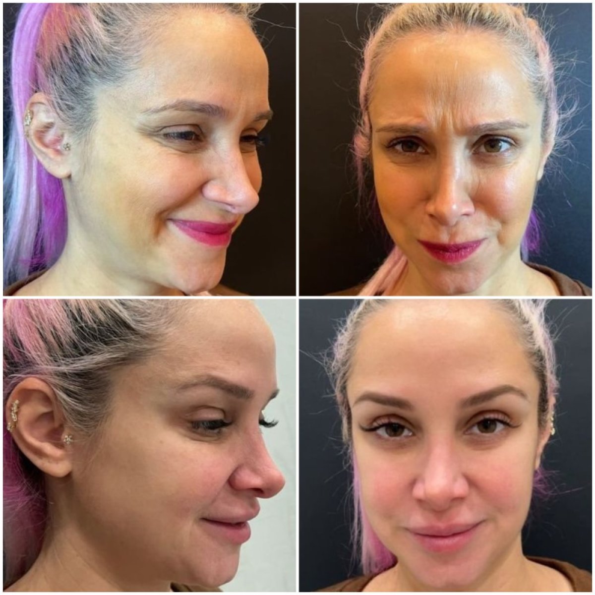 Photo Avant et Après des injections de Botox | Bookimed, image size:1200x1200