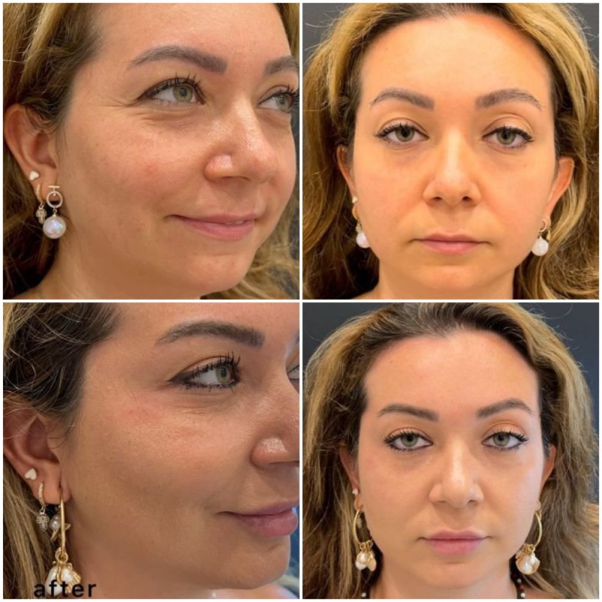 Photo Avant et Après des injections de Botox | Bookimed, image size:1200x1200