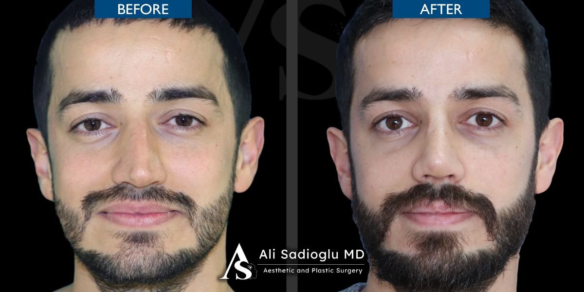 نتائج عملية تجميل الأنف قبل وبعد في عيادة Dr. Safa Manav، تحسين شكل الأنف وتناسقه