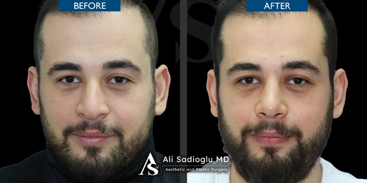 Resultados de rinoplastia antes y después en Dr. Safa Manav Clinic, forma de nariz mejorada