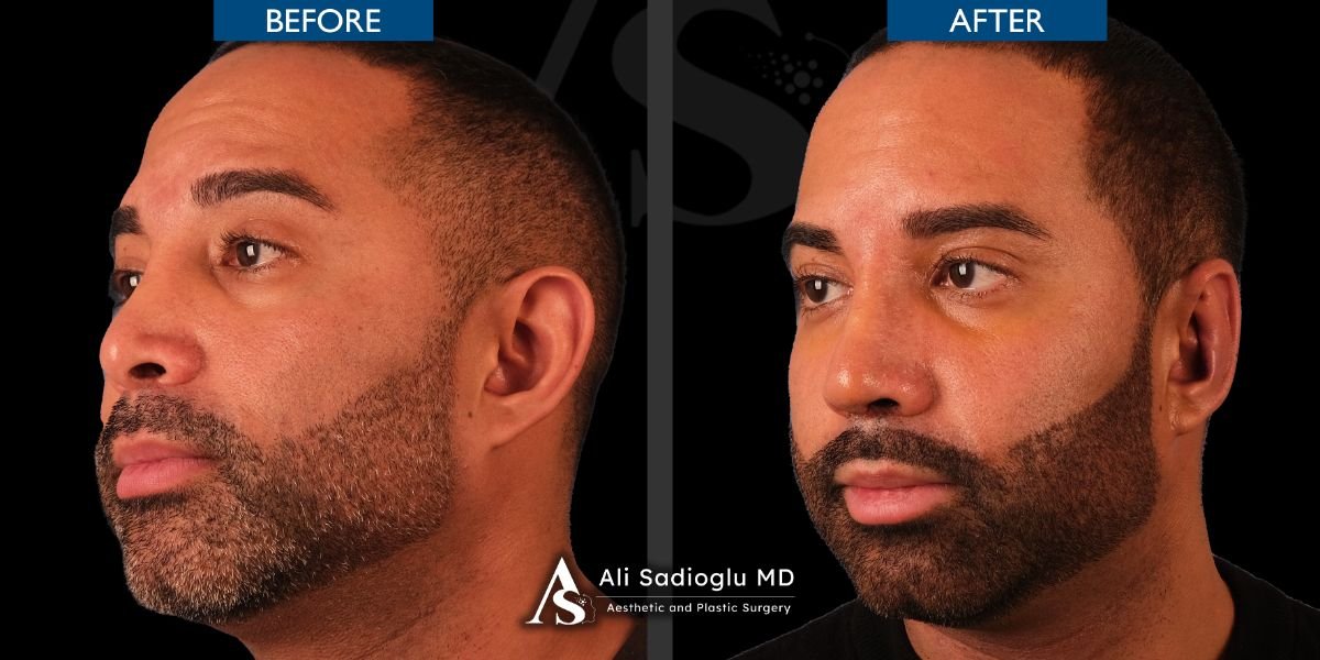 Resultados de trasplante de barba antes y después en Dr. Safa Manav Clinic, barba más densa