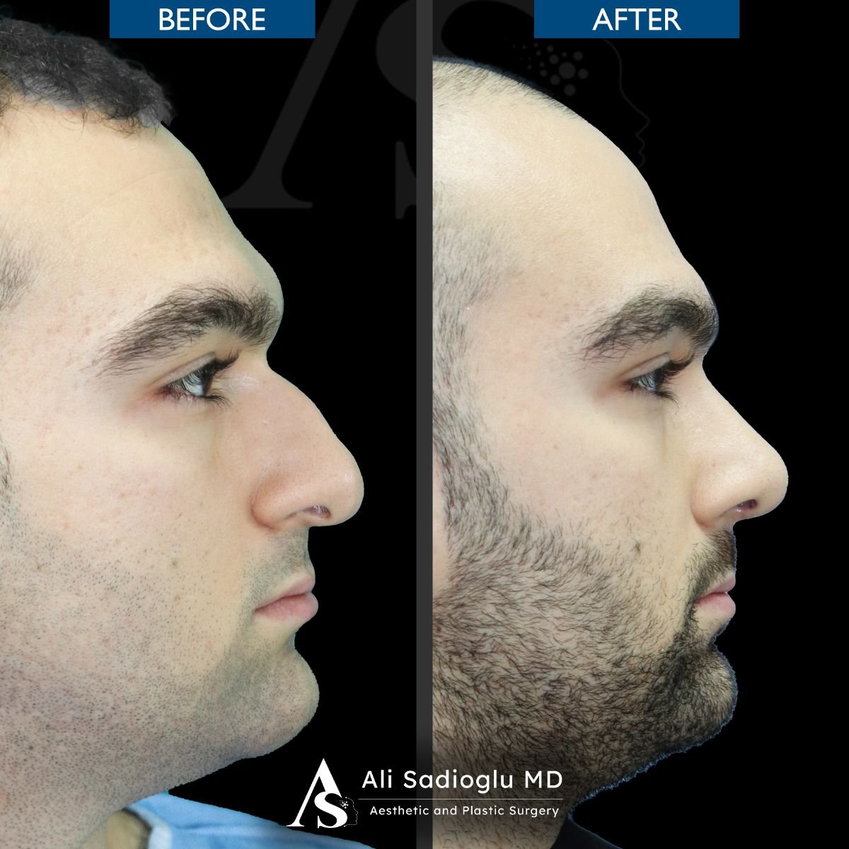 نتائج عملية تجميل الأنف قبل وبعد في عيادة Dr. Safa Manav، تحسين شكل الأنف