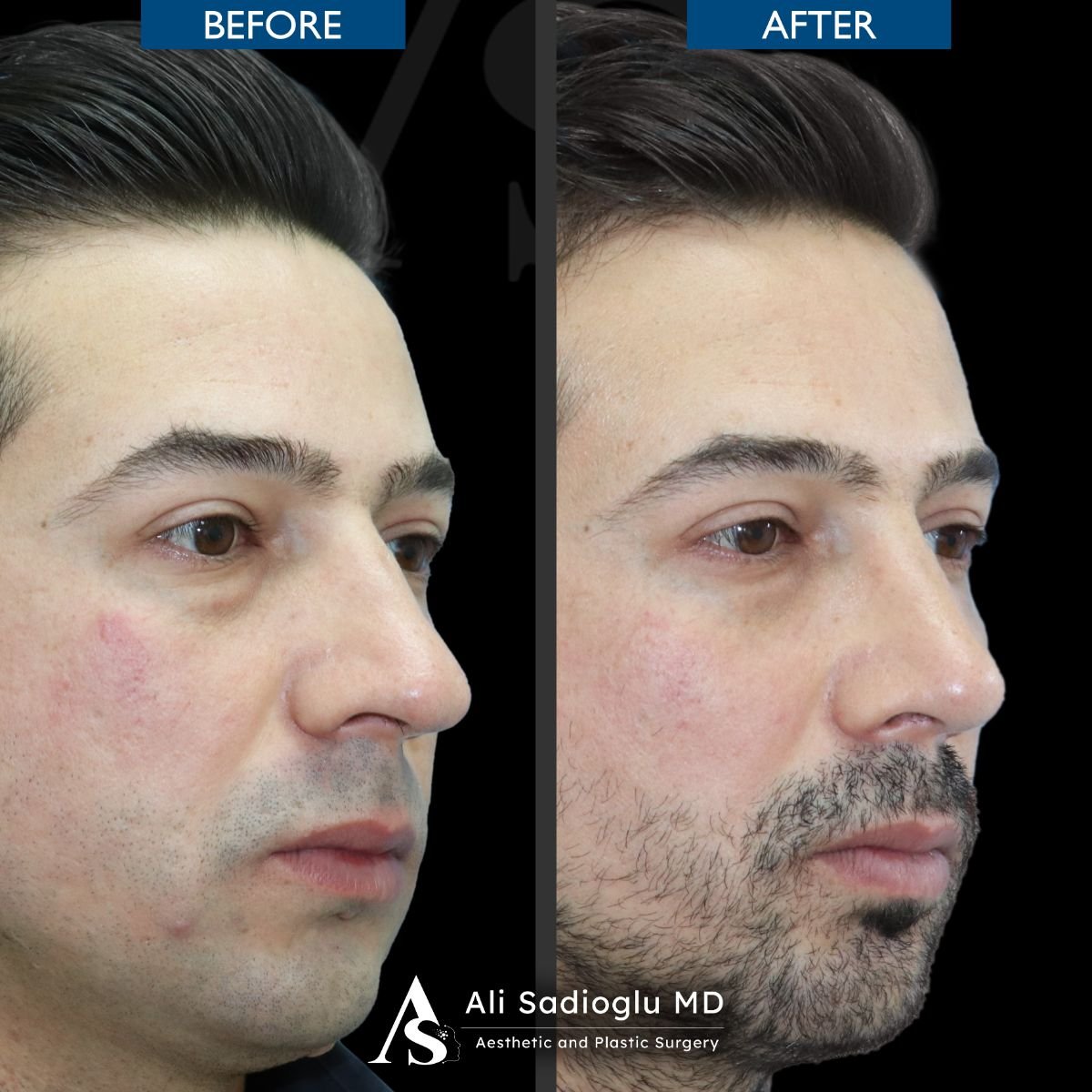 نتائج عملية تجميل الأنف قبل وبعد في عيادة Dr. Safa Manav، تحسين شكل الأنف لدى رجل