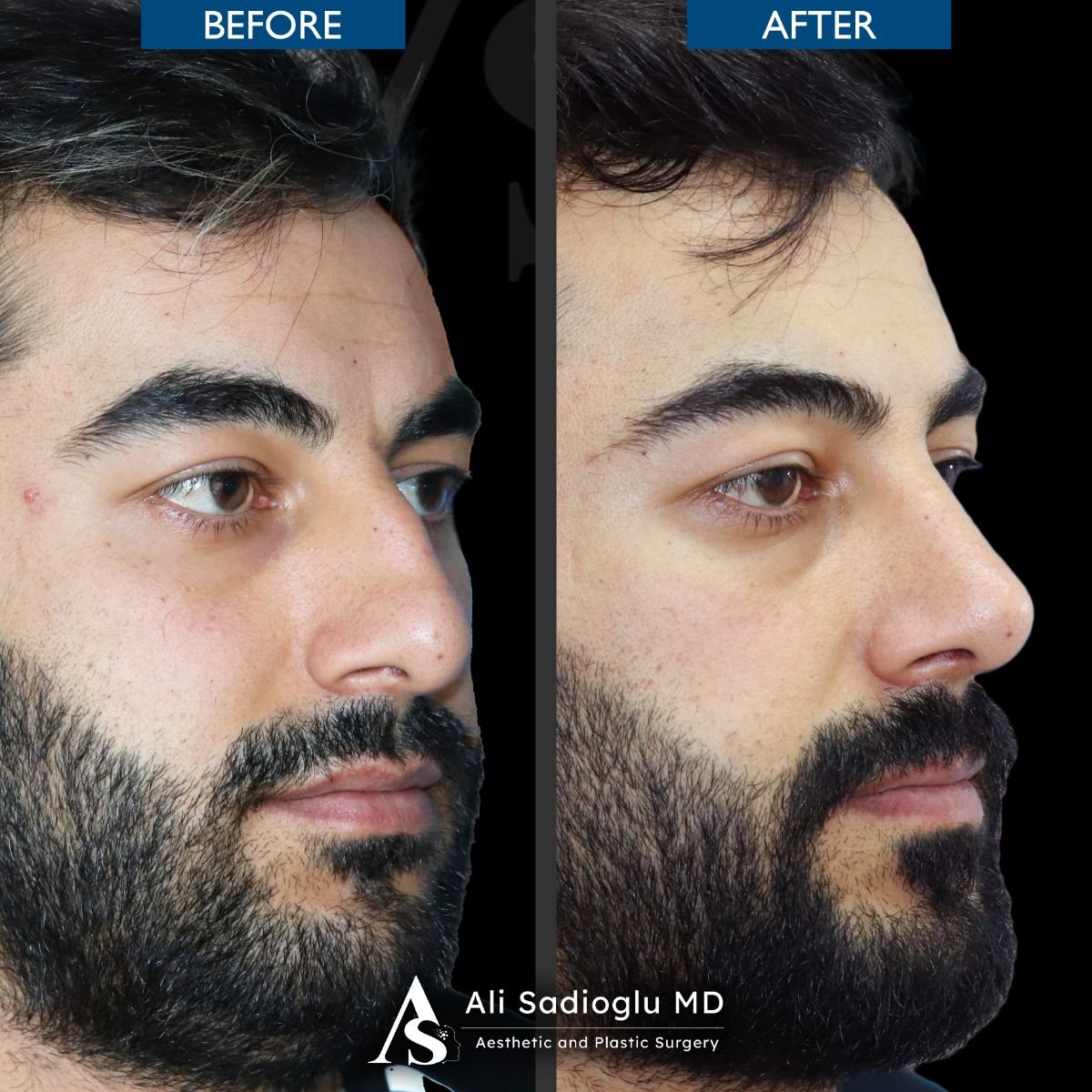 Resultados de rinoplastia antes y después en Dr. Safa Manav Clinic, mejora de la nariz masculina