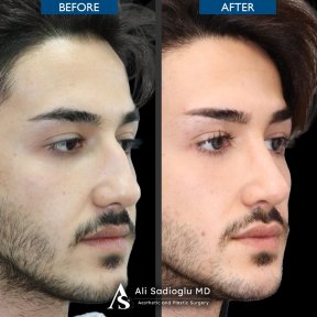 Premium Rhinoplasty (nose job) All Included - photo 4