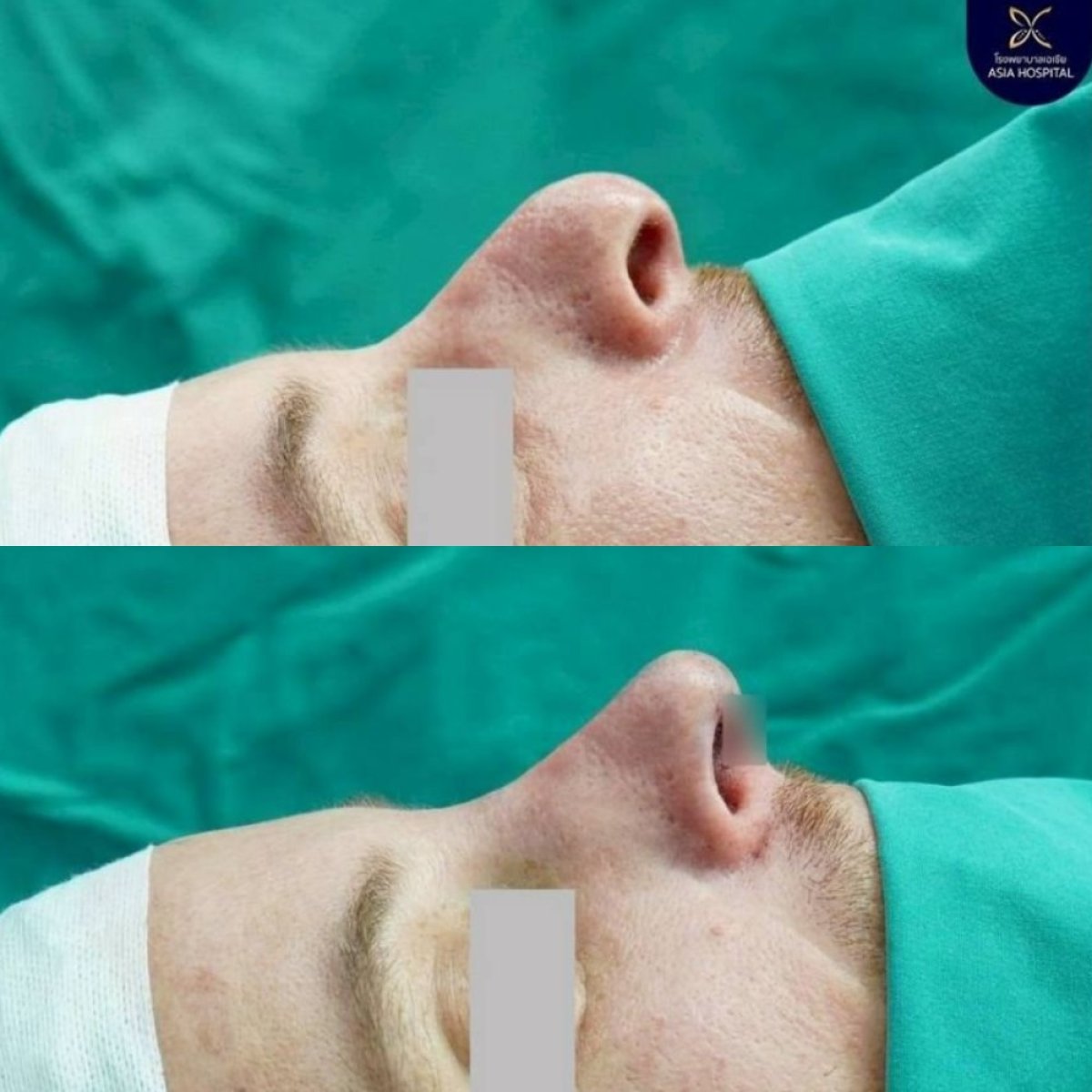 Before and after rhinoplasty results at Asia Cosmetic Hospital, improved nose profile shape