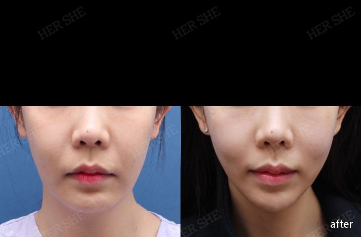 Результаты до и после нитевого лифтинга в HERSHE Plastic Surgery Korea, улучшение контура лица