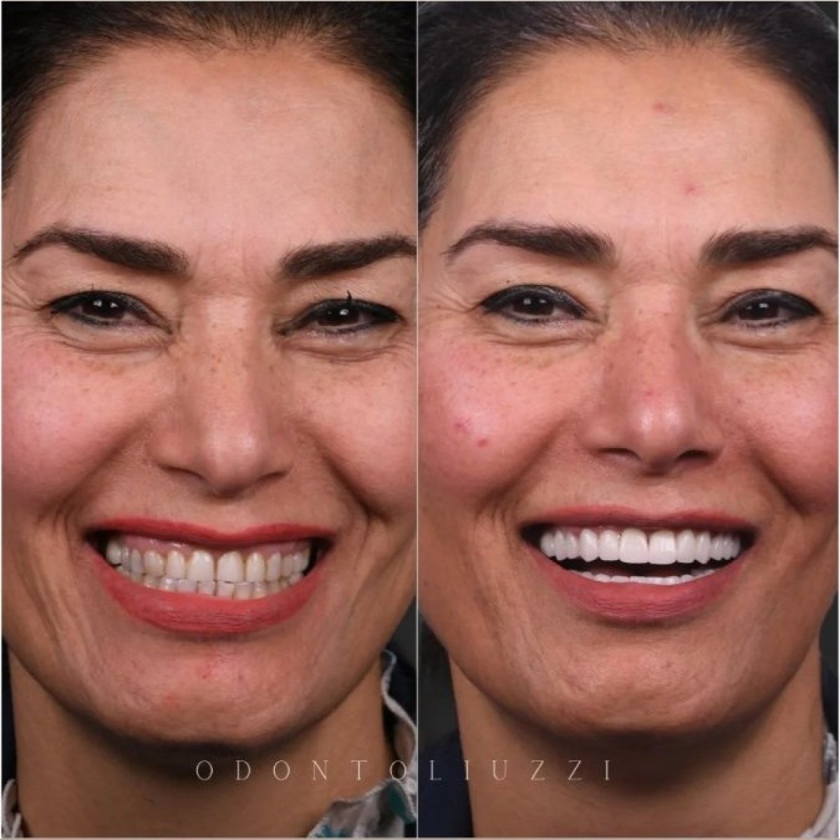 نتائج تبييض الأسنان قبل وبعد في Odontoliuzzi Dentistry and Health، ابتسامة أكثر إشراقًا