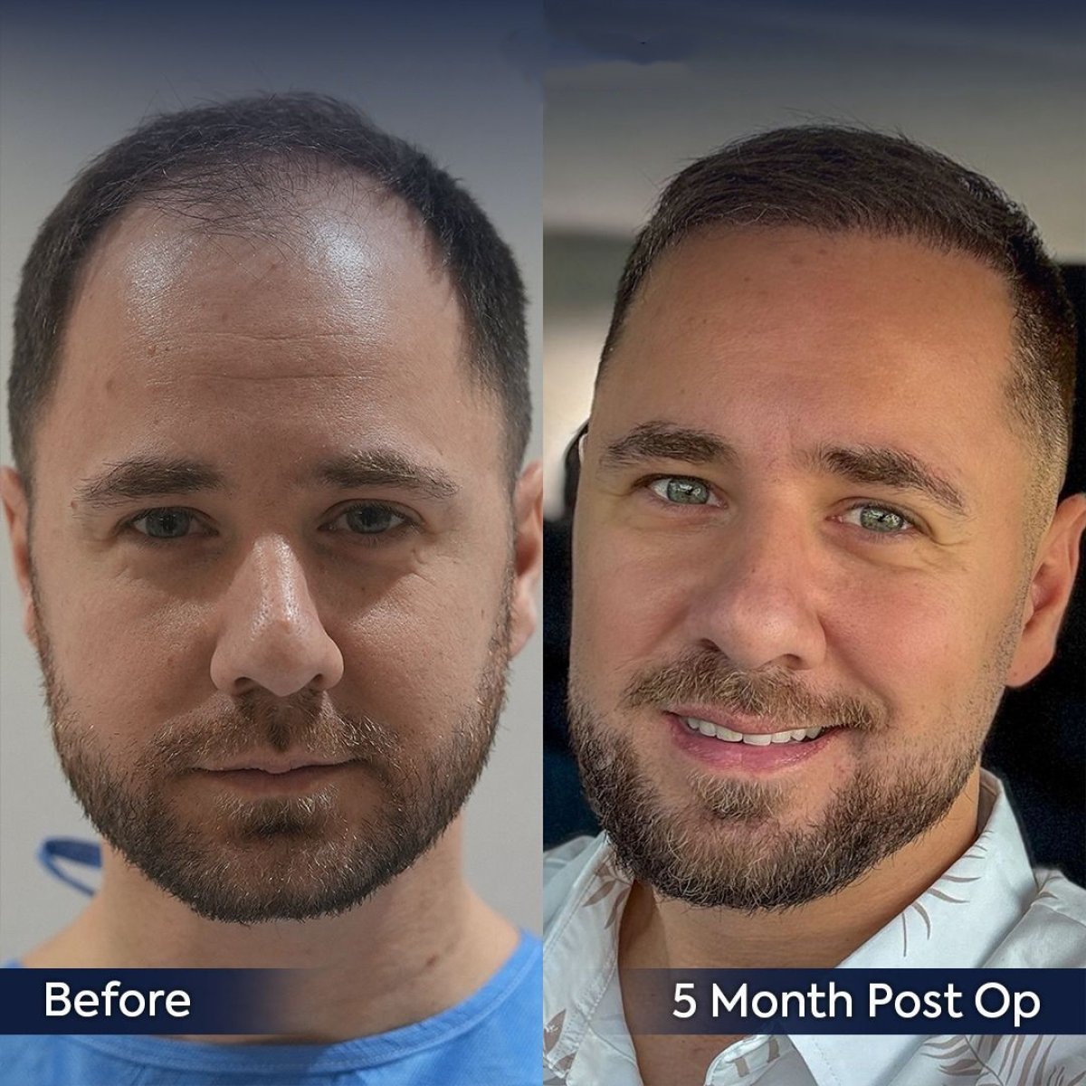 Before and after hair transplant results at Dr. Safa Manav Clinic, 5 months post-op