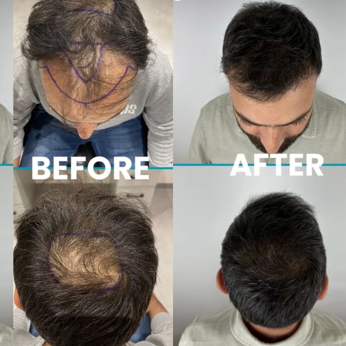 Resultados de trasplante capilar antes y después en Dr. Safa Manav Clinic, mayor densidad