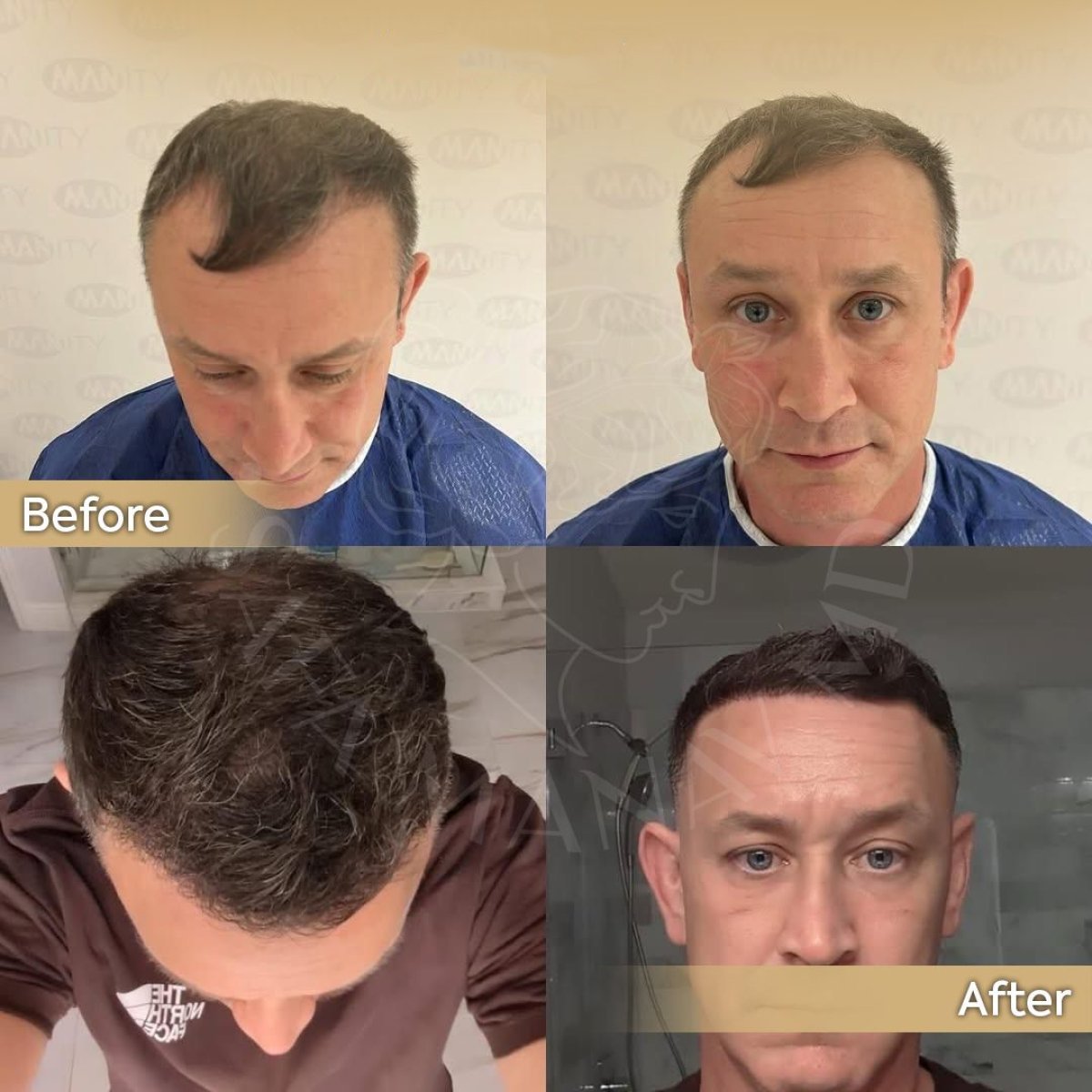 Before and after hair transplant results at Dr. Safa Manav Clinic, restored hairline in male patient