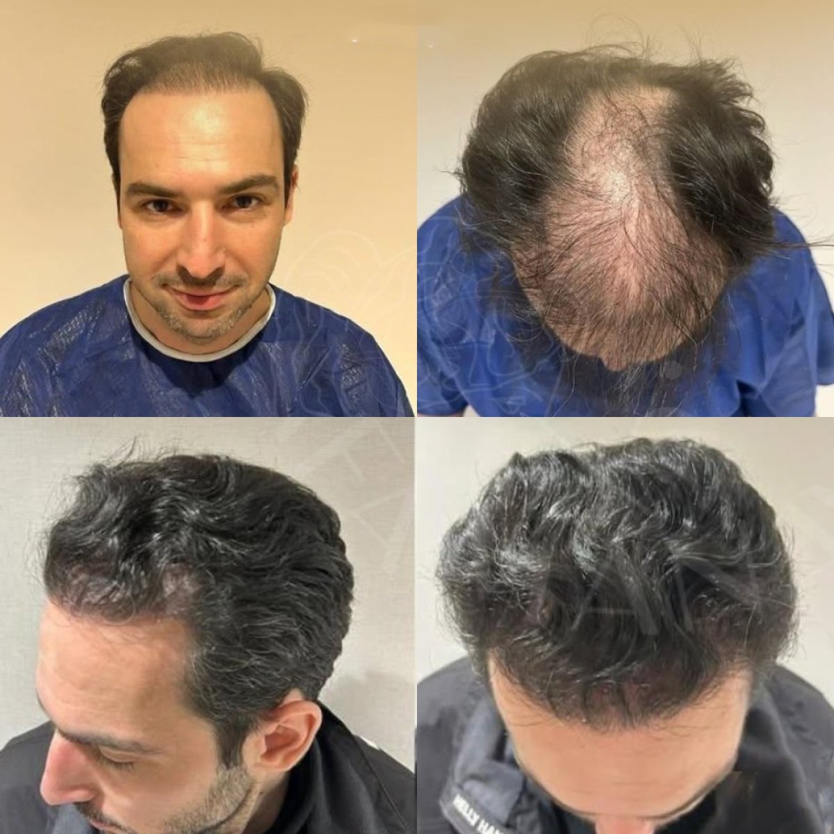 Before and after hair transplant results at Dr. Safa Manav Clinic, restored hairline and density