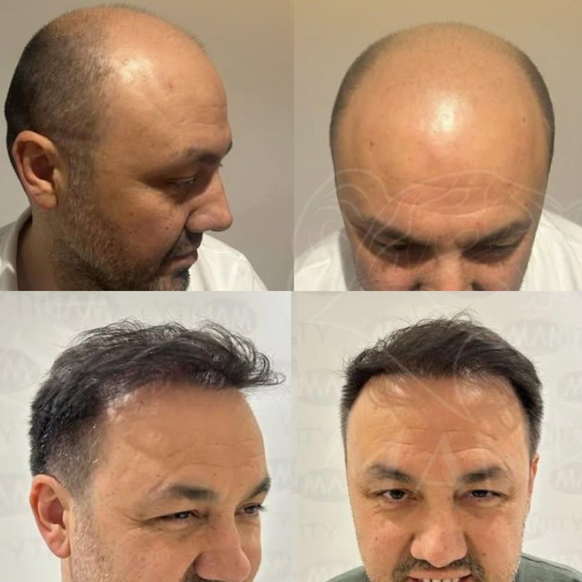 Résultats avant et après greffe de cheveux à la clinique Dr. Safa Manav, ligne capillaire restaurée