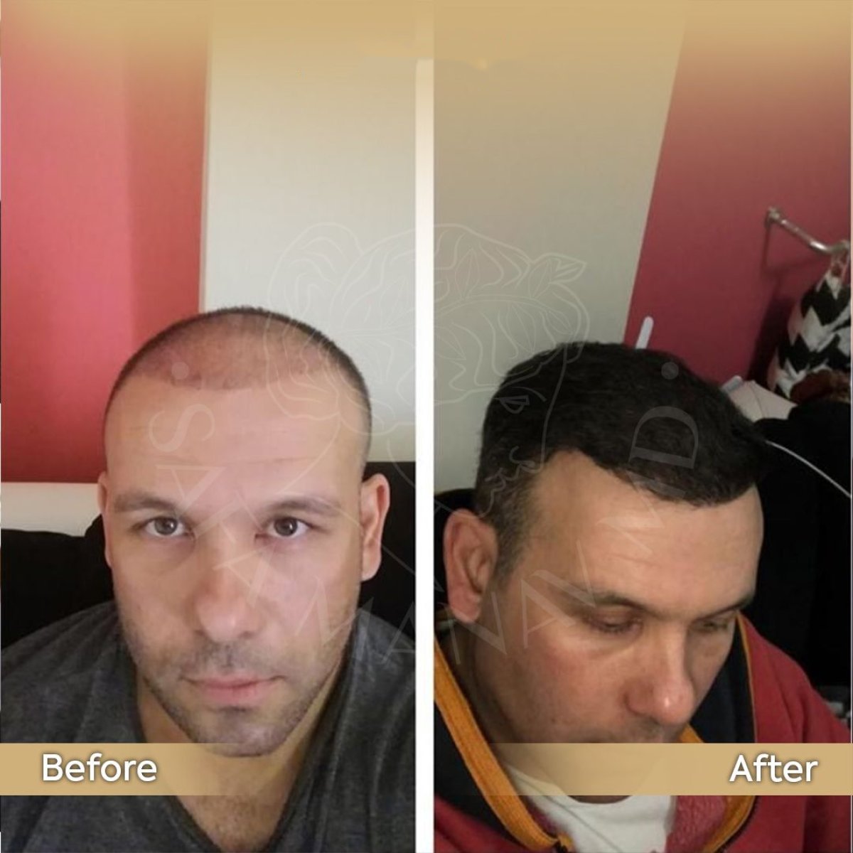 Resultados de trasplante capilar antes y después en Dr. Safa Manav Clinic, línea restaurada