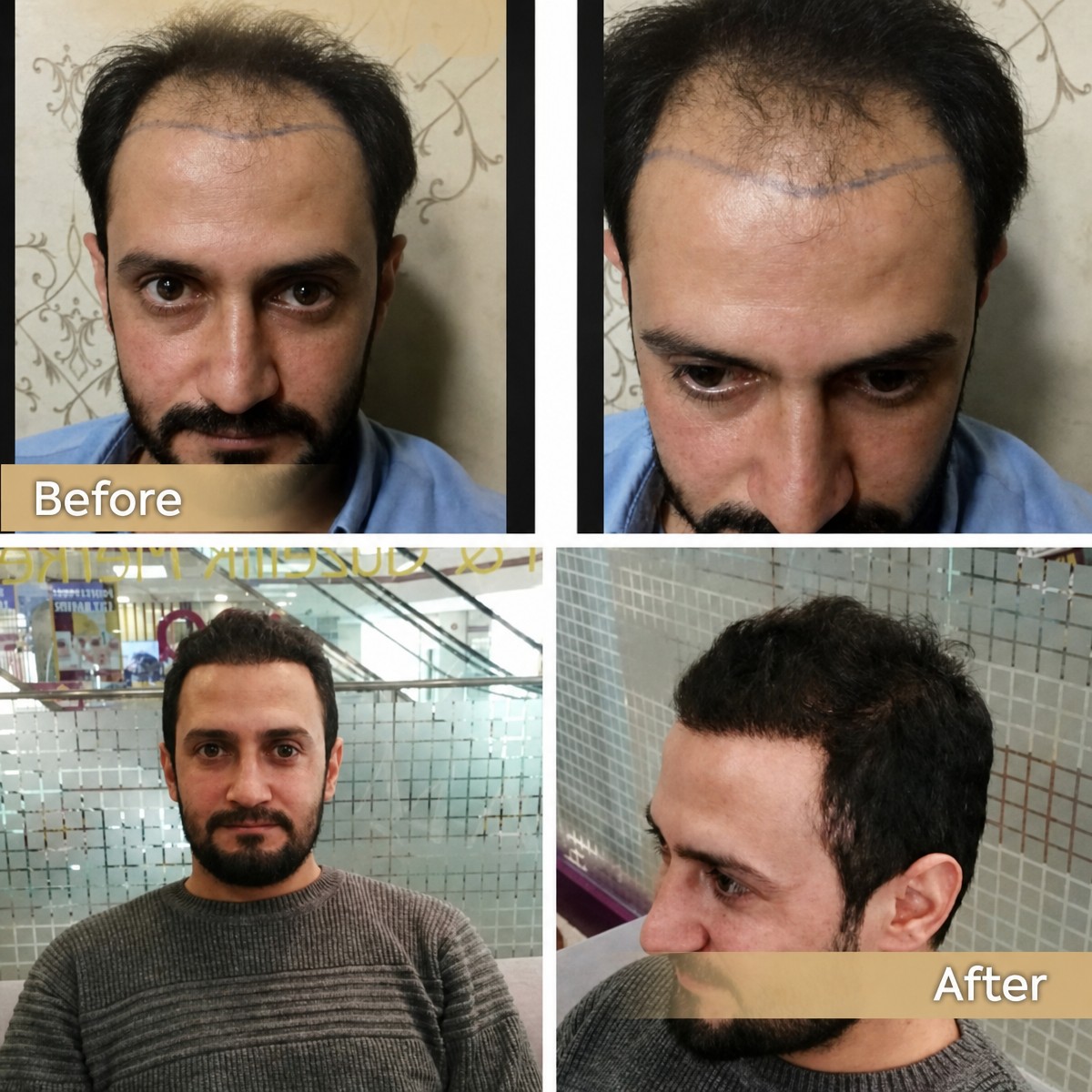 Before and after hair transplant results at Dr. Safa Manav Clinic, restored hairline in male patient