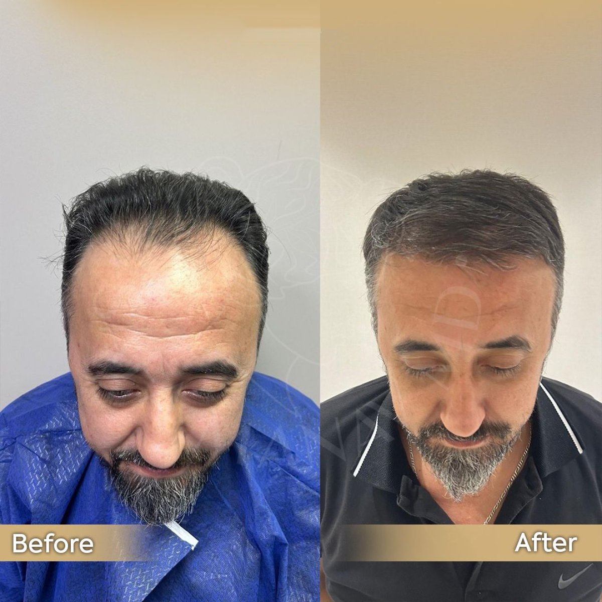 Resultados de trasplante capilar antes y después en Dr. Safa Manav Clinic, línea restaurada