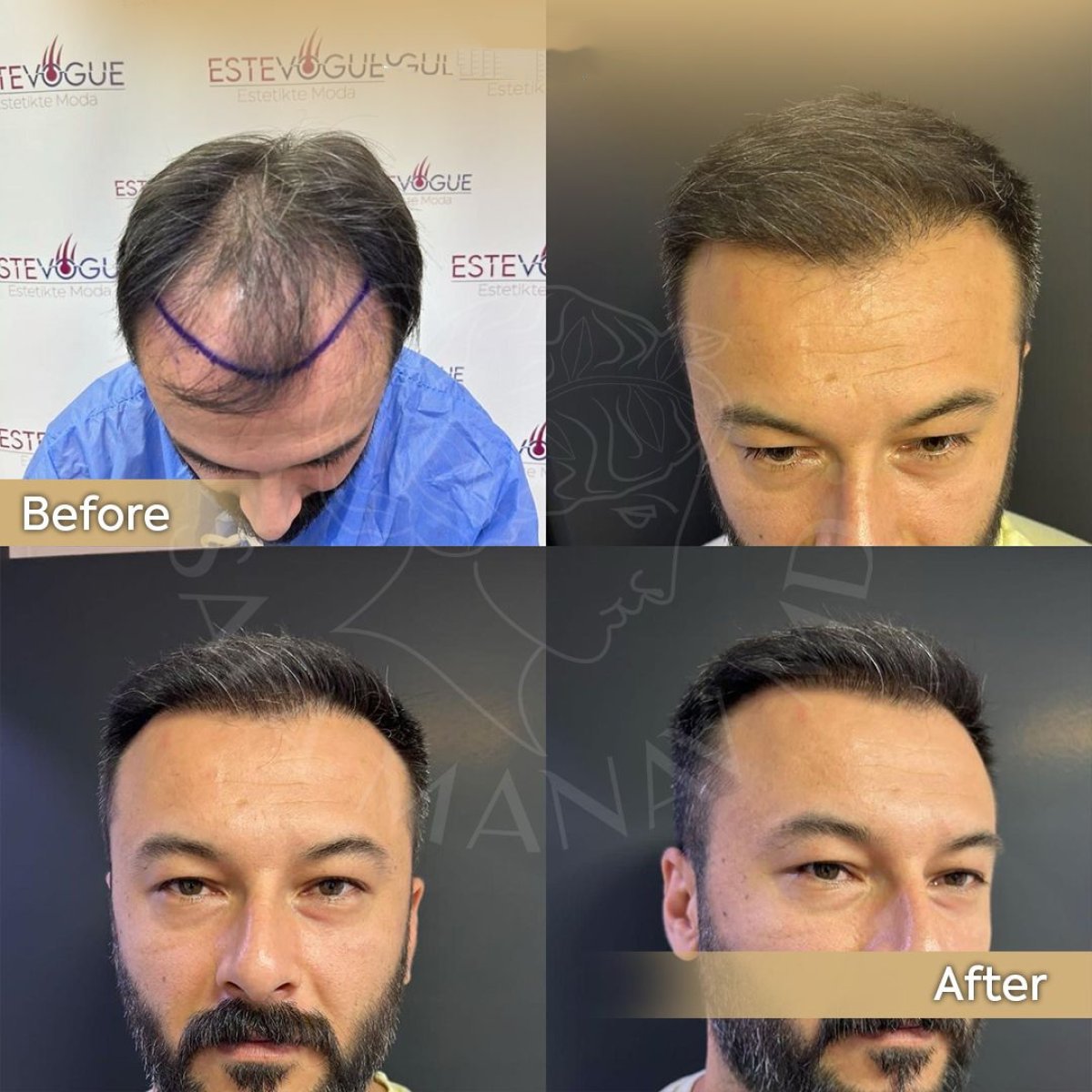 Vorher-nachher-Ergebnis der Haartransplantation bei Dr. Safa Manav Clinic mit vollerem Haaransatz
