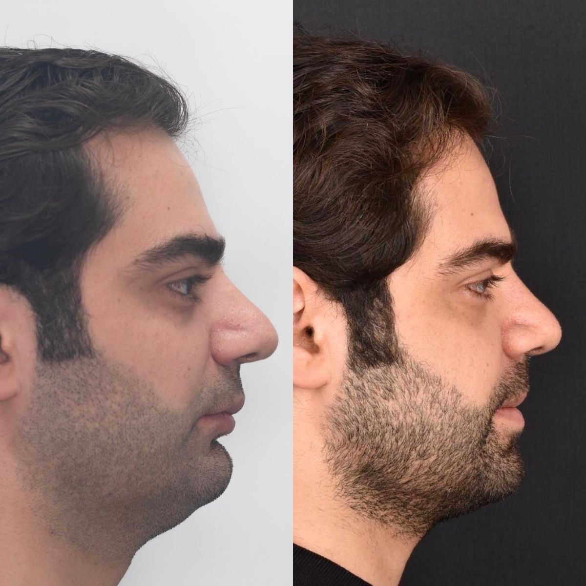 Antes y después de genioplastia en Dentavie Istanbul Dental Clinic, mejora del perfil de la barbilla