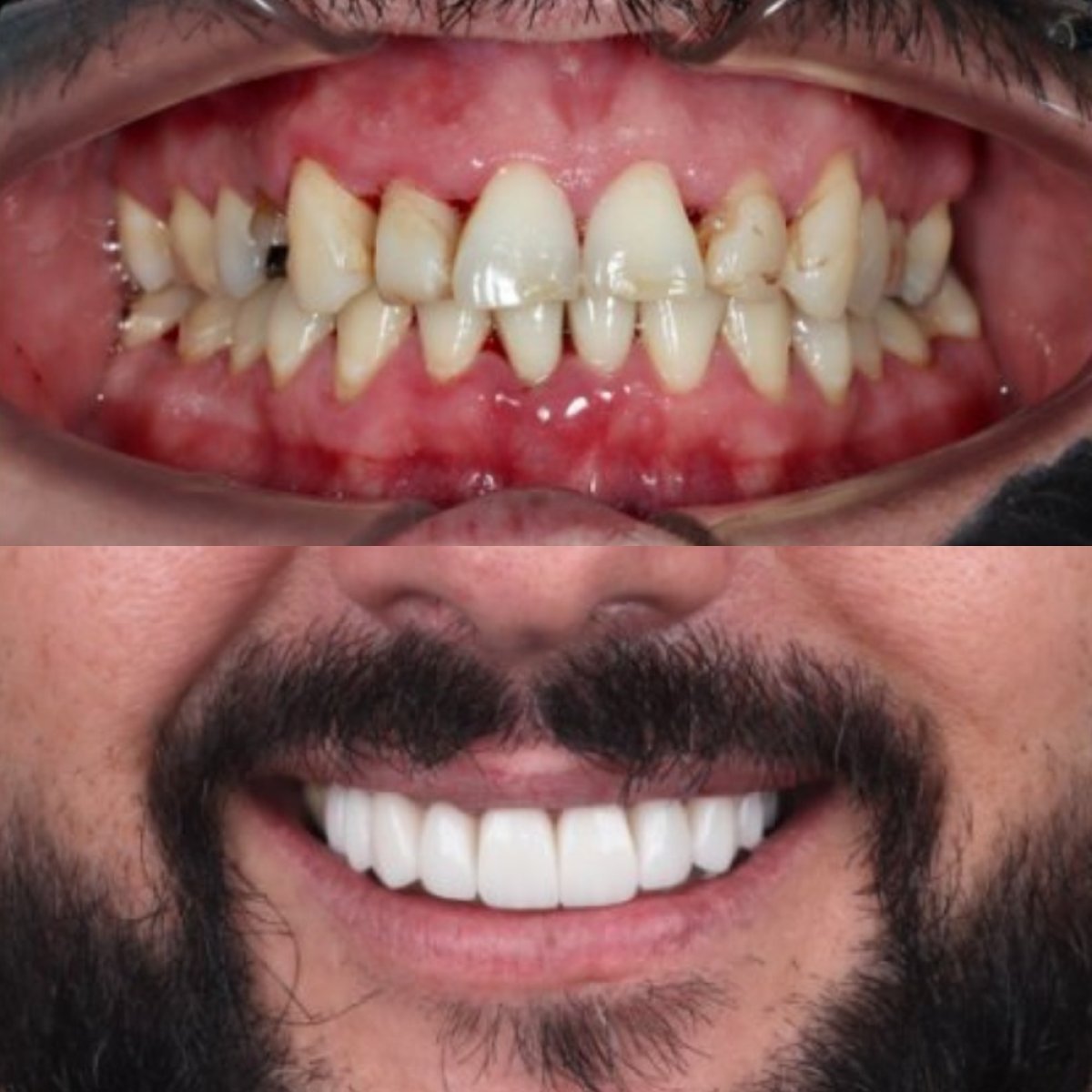 نتيجة قبل وبعد الفينير في SmileBox Dental Clinic - Thonglor, Sukhumvit Branch، تجميل الابتسامة