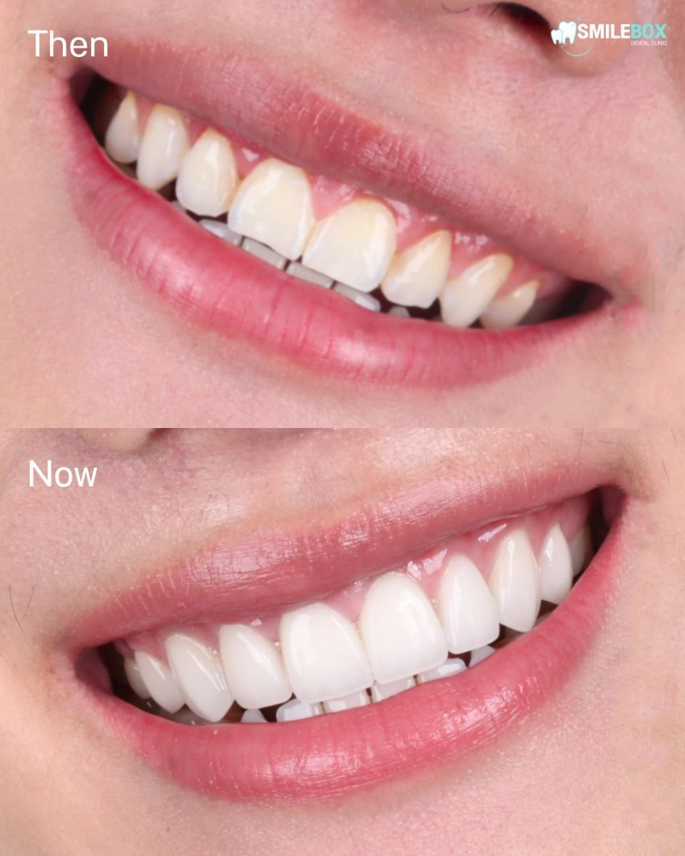Результат до та після встановлення вініров у SmileBox Dental Clinic - Thonglor, Sukhumvit Branch