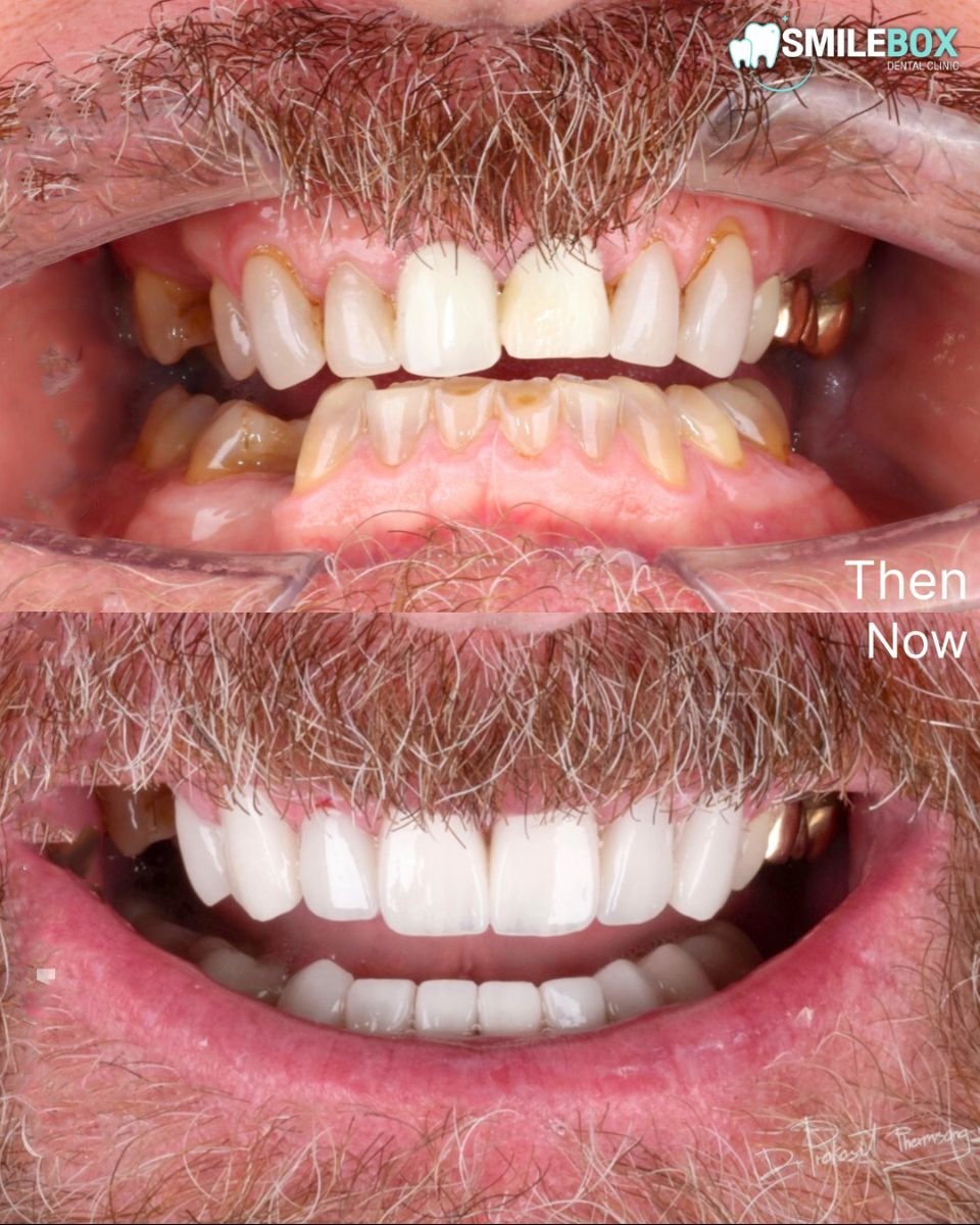 Before and after veneers result at SmileBox Dental Clinic - Thonglor, Sukhumvit Branch
