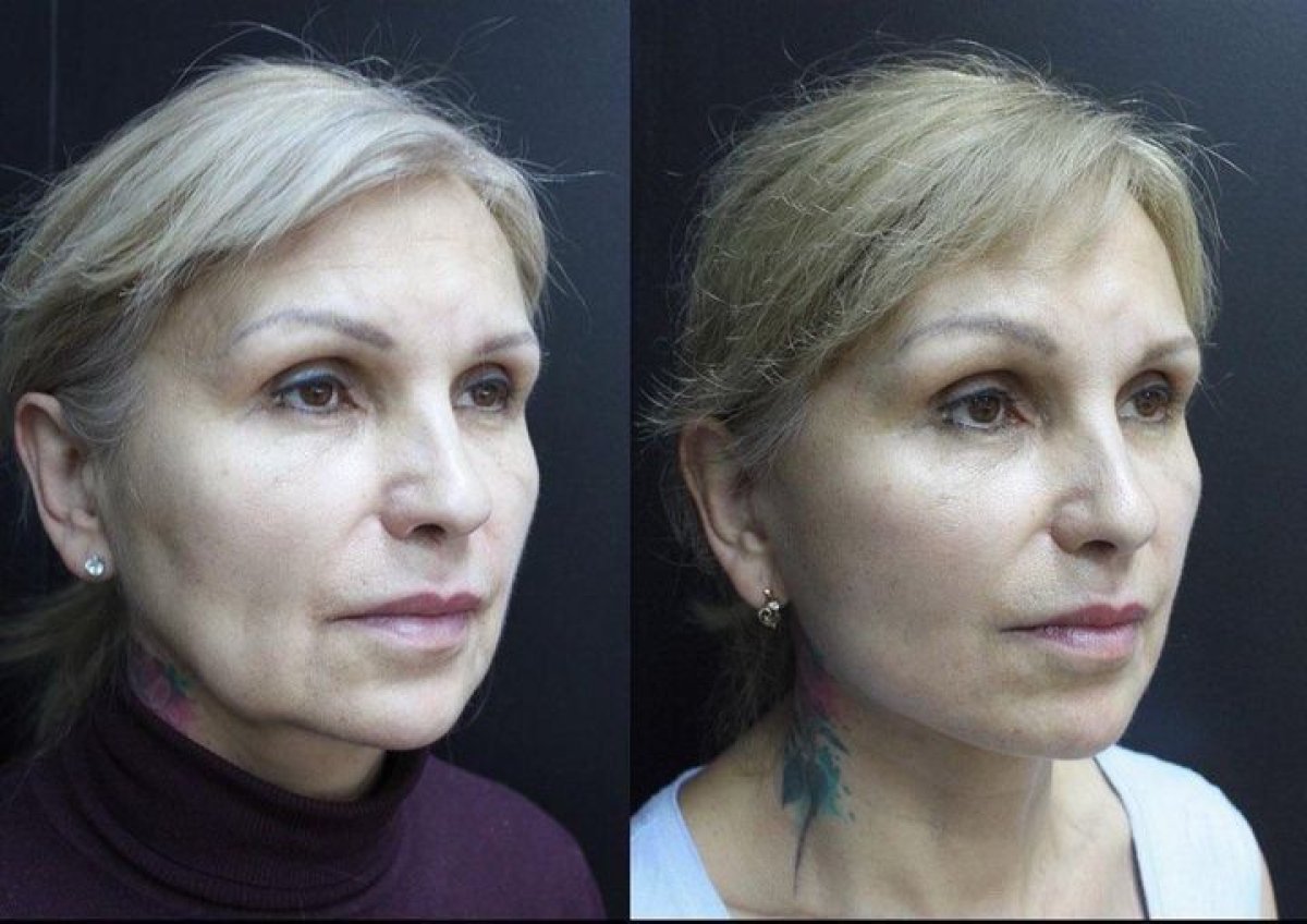 Before and after neck lift results at Dmytrii Homola Clinic, visible neck and jawline improvement