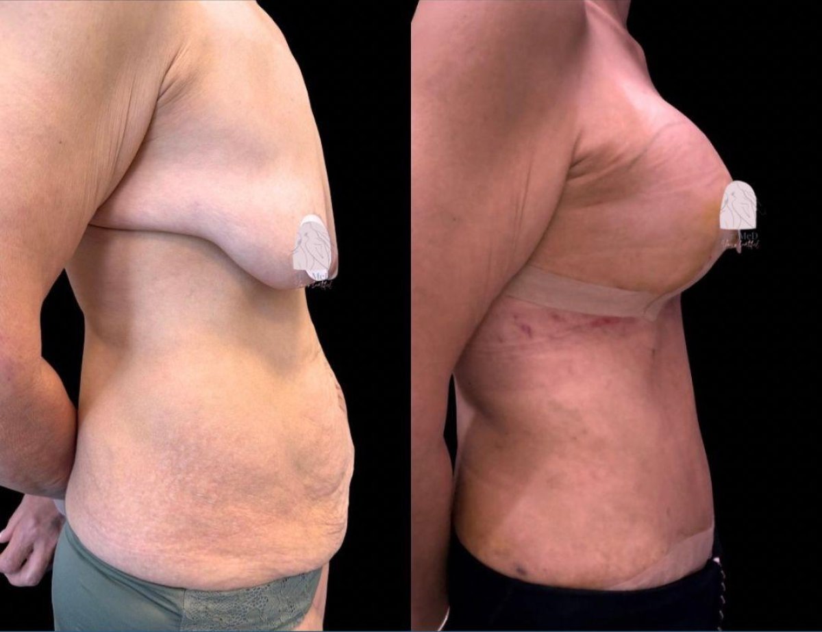 Before and after mommy makeover at Dr. MED – visible breast lift and tummy contour result