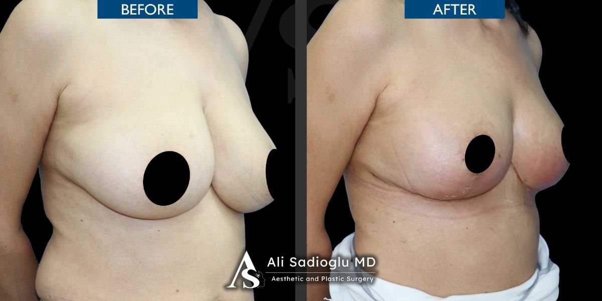 Résultats avant/après lifting mammaire avec implants ronds à la clinique Dr. Safa Manav